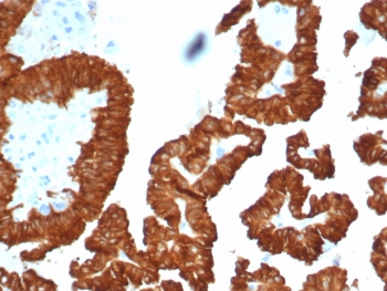 IHC staining of FFPE human kidney cancer with Crystallin Alpha B antibody (clone CRYAB/4661). HIER: boil tissue sections in pH 9 10mM Tris with 1mM EDTA for 20 min and allow to cool before testing.~