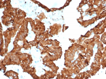 IHC staining of FFPE human kidney cancer with Crystallin Alpha B antibody (clone CRYAB/4657). HIER: boil tissue sections in pH 9 10mM Tris with 1mM EDTA for 20 min and allow to cool before testing.~