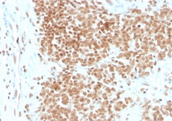 IHC staining of FFPE human Ewing's Sarcoma (EWS) with FLI1 antibody (clone FLI1/4371R). HIER: boil tissue sections in pH 9 10mM Tris with 1mM EDTA for 20 min and allow to cool before testing.~