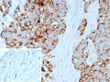 IHC staining of FFPE human bladder carcinoma with