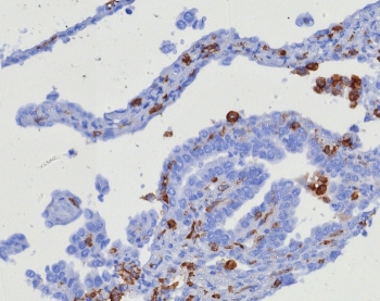 IHC staining of FFPE human ovarian carcinoma tissue with CD163 antibody (clone M130/8361R). HIER: boil tissue sections in pH 9 10mM Tris with 1mM EDTA for 20 min and allow to cool before testing.~