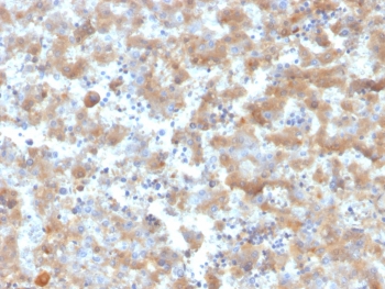 IHC staining of FFPE human liver tissue with Alpha-2-Macroglobulin antibody (clone A2M/6555). HIER: boil tissue sections in pH 9 10mM Tris with 1mM EDTA for 20 min and allow to cool before testing.~