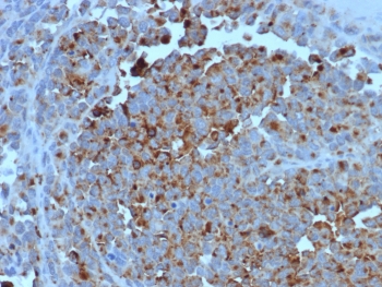 IHC staining of FFPE human melanoma tissue with CD63 antibody (clone LAMP3/7369). HIER: boil tissue sections in pH 9 10mM Tris with 1mM EDTA for 20 min and allow to cool before testing.~