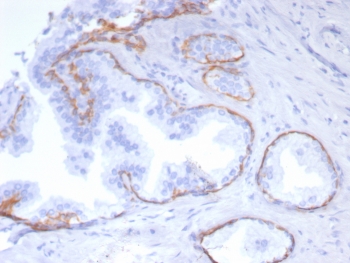 IHC staining of FFPE human prostate tissue with recombinant KRT5 antibody (clone rKRT5/6969). HIER: boil tissue sections in pH 9 10mM Tris with 1mM EDTA for 20 min and allow to cool before testing.~