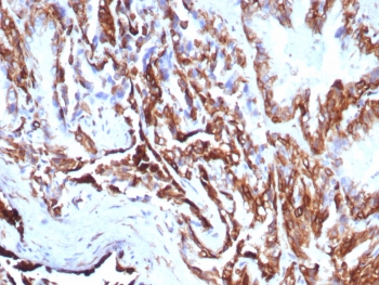 IHC staining of FFPE human prostate carcinoma tissue with recombinant KRT7 antibody (clone rKRT7/8763). HIER: boil tissue sections in pH 9 10mM Tris with 1mM EDTA for 20 min and allow to cool before testing.~