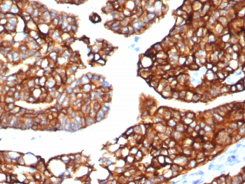 IHC staining of FFPE human lung carcinoma