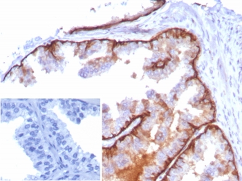 IHC staining of FFPE human tonsil tissue with Cytokeratin 5 antibody (clone KRT5/8814R). Inset: PBS used in place of primary Ab (secondary Ab negative control). HIER: boil tissue sections in pH 9 10mM Tris with 1mM EDTA for 20 min and allow to cool before testing.~