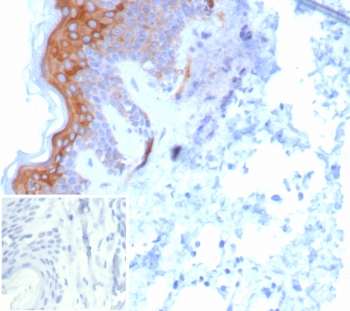 IHC staining of FFPE human skin tissue with KRT6 antibody (clone KRT6/8267R). Inset: PBS used in place of primary Ab (secondary Ab negative control). HIER: boil tissue sections in pH 9 10mM Tris with 1mM EDTA for 20 min and allow to cool before testing.~