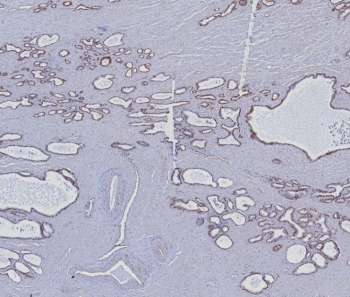 IHC staining of FFPE human prostate carcinoma tissue with Cytokeratin 5/6 antibody (clone KRT5.6/8275R). HIER: boil tissue sections in pH 9 10mM Tris with 1mM EDTA for 20 min and allow to cool before testing.~
