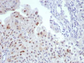 IHC staining of FFPE human bladder tissue with MDM2 antibody (clone MDM2/7190R). HIER: boil tissue sections in pH 9 10mM Tris with 1mM EDTA for 20 min and allow to cool before testing.~