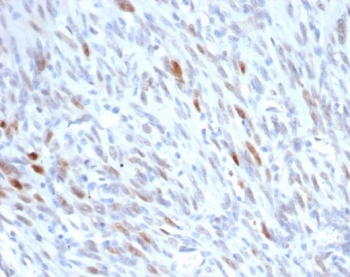 IHC staining of FFPE human liposarcoma tissue with MD