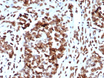 IHC staining of FFPE human ovarian cancer tissue with MDM2 antibody (clone MDM2/7942). HIER: boil tissue sections in pH 9 10mM Tris with 1mM EDTA for 20 min and allow to cool before testing.~