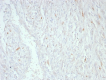 IHC staining of FFPE human liposarcoma tissue with MDM2 antibody (clone MDM2/8221). HIER: boil tissue sections in pH 9 10mM Tris with 1mM EDTA for 20 min and allow to cool before testing.~