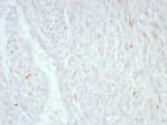IHC staining of FFPE human liposarcoma tissue with MDM2 antibody (clone MDM2/8221). HIER: boil tissue sections in pH 9 10mM Tris with 1mM EDTA for 20 min and allow to cool before testing.