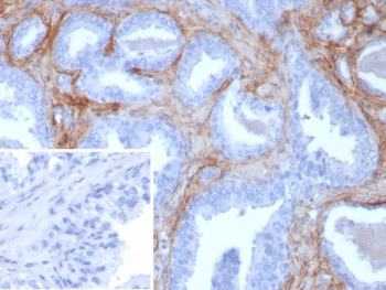 IHC staining of FFPE human prostate tissue with recombinant POSTN antibody (clone rPOSTN/8522). Inset: PBS used in place of primary Ab (secondary Ab negative control). HIER: boil tissue sections in pH 9 10mM Tris with 1mM EDTA for 20 min and allow to cool before testing.~