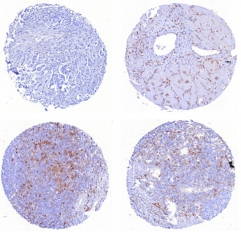 IHC staining of FFPE human (1) mammary carcinoma (2)