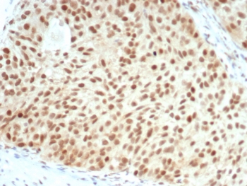 IHC staining of FFPE human bladder carcinoma with recombinant Retinoblastoma antibody (clone RB1/7080R). HIER: boil tissue sections in pH 9 10mM Tris with 1mM EDTA for 20 min and allow to cool before testing.~
