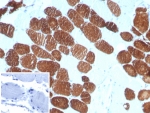 IHC staining of FFPE human breast carcinoma tissue with Myosin 7 antibody (clone MYH7/727). Inset: PBS used in place of primary Ab (secondary Ab negative control). HIER: boil tissue sections in pH 9 10mM Tris with 1mM EDTA for 20 min and allow to cool before testing.