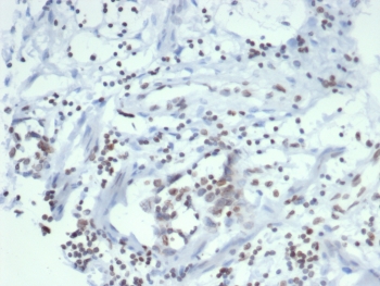 IHC staining of FFPE human ovarian carcinoma tissue with Estrogen Sulfotransferase antibody (clone SULT1E1/7124). HIER: boil tissue sections in pH 9 10mM Tris with 1mM EDTA for 20 min and allow to cool before testing.~