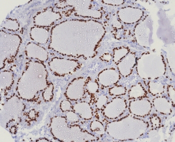 IHC staining of FFPE human lung adenocarcinoma tissue with NKX2.1 antibody (clone TTF1/8123R). HIER: boil tissue sections in pH 9 10mM Tris with 1mM EDTA for 20 min and allow to cool before testing.~