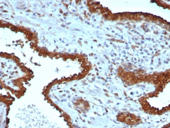 IHC staining of FFPE human prostate tissue with Galectin-3 antibody (clone LGALS3/6583). HIER: boil tissue sections in pH 9 10mM Tris with 1mM EDTA for 20 min and allow to cool before testing.~