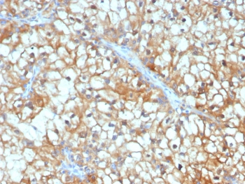IHC staining of FFPE human renal cell carcinoma tissue with TGF beta 3 antibody (clone TGFB3/4801). HIER: boil tissue sections in pH 9 10mM Tris with 1mM EDTA for 20 min and allow to cool before testing.~