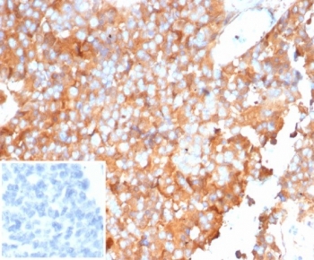 IHC staining of FFPE human ovarian carcinoma tissue with SERPINA1 antibody (clone AAT/6323). Inset: PBS used in place of primary Ab (secondary Ab negative control). HIER: boil tissue sections in pH 9 10mM Tris with 1mM EDTA for 20 min and allow to cool before testing.~