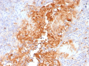 IHC staining of FFPE human tonsil tissue with Alpha-1-Antitrypsin antibody (clone AAT/4490). HIER: boil tissue sections in pH 9 10mM Tris with 1mM EDTA for 20 min and allow to cool before testing.~