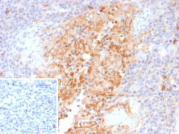 IHC staining of FFPE human tonsil tissue with Alpha-1-Antitrypsin antibody (clone AAT/4571). Inset: PBS used in place of primary Ab (secondary Ab negative control). HIER: boil tissue sections in pH 9 10mM Tris with 1mM EDTA for 20 min and allow to cool before testing.~