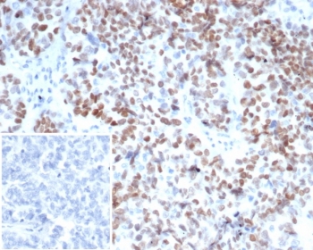 IHC staining of FFPE human ovarian carcinoma tissue with MEIS2 antibody (