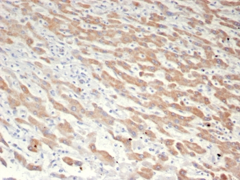 IHC staining of FFPE human liver in HCC with GFRP antibody (clone GCHFR/7731). HIER: boil tissue sections in pH 9 10mM Tris with 1mM EDTA for 20 min and allow to cool before testing.~