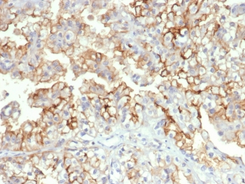 IHC staining of FFPE human kidney carcinoma tissue with CD276 antibody (clone B7H3/4312) at 2ug/ml. HIER: boil tissue sections in pH 9 10mM Tris with 1mM EDTA for 20 min and allow to cool before testing.