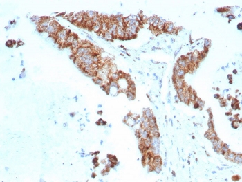 IHC staining of FFPE human colon carci