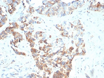 IHC staining of FFPE human gastric carcinoma with TNFRSF17 antibody (clone BCMA/7253). HIER: boil tissue sections in pH 9 10mM Tris with 1mM EDTA for 20 min and allow to cool before testing.~