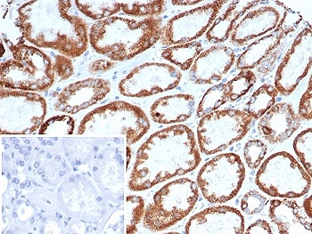 IHC staining of FFPE human gastric carcinoma ti