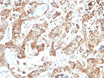 IHC staining of FFPE human colon carcinoma tissue with CD269 antibody (clone BCMA/7254). HIER: boil tissue sections in pH 9 10mM Tris with 1mM EDTA for 20 min and allow to cool before testing.~