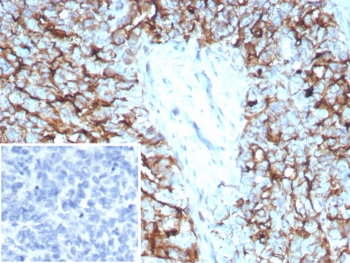 IHC staining of FFPE human ovarian cancer tissue with recombinant Mesothelin antibody (MSLN/8391R). Inset: PBS used in place of primary Ab (secondary Ab negative control). HIER: boil tissue sections in pH 9 10mM Tris with 1mM EDTA for 20 min and allow to cool before testing.~
