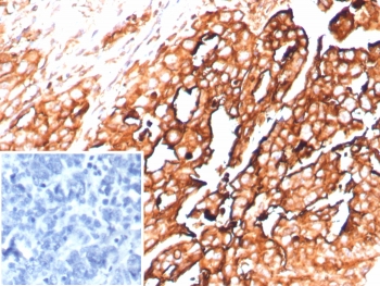 IHC staining of FFPE human ovarian cancer tissue with recombinant MSLN antibody (clone rMSLN/8764). Inset: PBS used in place of primary Ab (secondary Ab negative control). HIER: boil tissue sections in pH 9 10mM Tris with 1mM EDTA for 20 min and allow to cool before testing.~