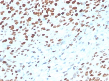 IHC staining of FFPE human bladder tissue with TP53 antibody (clone rTP53/3889). HIER: boil tissue sections in pH 9 10mM Tris with 1mM EDTA for 20 min and allow to cool before testing.~