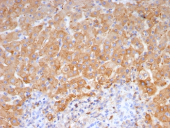 IHC staining of FFPE human hepatocellular carcinoma tissue with Haptoglobin antibody (clone HP/4815). HIER: boil tissue sections in pH 9 10mM Tris with 1mM EDTA for 20 min and allow to cool before testing.~