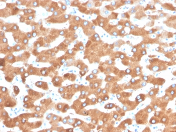 IHC staining of FFPE human liver carcinoma in colon with Haptoglobin antibody (clone HP/3832). HIER: boil tissue sections in pH 9 10mM Tris with 1mM EDTA for 20 min and allow to cool before testing.~