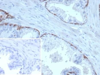 IHC staining of FFPE human prostate carcinoma tissue with Cytokeratin 14 antibody (clone KRT14/6962). Inset: PBS used in place of primary Ab (secondary Ab negative control). HIER: boil tissue sections in pH 9 10mM Tris with 1mM EDTA for 20 min and allow to cool before testing.~
