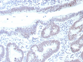 IHC staining of FFPE human colon carcinoma tissue with recombinant TP53 antibody (clone rTP53/8993). HIER: boil tissue sections in pH 9 10mM Tris with 1mM EDTA for 20 min and allow to cool before testing.~