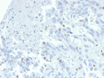 IHC staining of FFPE human tumor tissue (unknown origin) with ZNF232 an