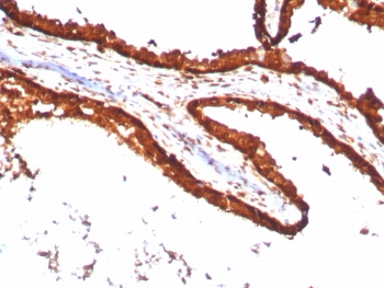 IHC staining of FFPE human prostate carcinoma tissue with recombinant 14-3-3E antibody (clone YWHAE/8636R). HIER: boil tissue sections in pH 9 10mM Tris with 1mM EDTA for 20 min and allow to cool before testing.~