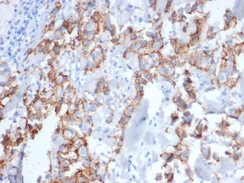IHC staining of FFPE human breast carcinoma tissue stained with recombinant ErbB2 antibody (clone rERBB2/6637) at 2ug/ml. HIER: boil tissue sections in pH 9 10mM Tris with 1mM EDTA for 20 min and allow to cool before testing.~