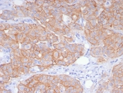 IHC staining of FFPE human breast carcinoma tissue with recombinant HER2 antibody (clone ERBB2/8142R). HIER: boil tissue sections in pH 9 10mM Tris with 1mM EDTA for 20 min and allow to cool before testing.