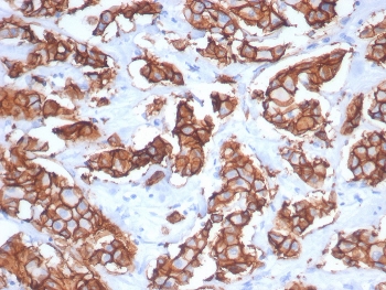 IHC staining of FFPE human breast carcinoma tissue with recombinant HER2 antibody (clone ERBB2/7158R). HIER: boil tissue sections in pH 9 10mM Tris with 1mM EDTA for 20 min and allow to cool before testing.~
