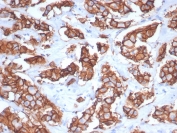 IHC staining of FFPE human breast carcinoma tissue with recombinant HER2 antibody (clone ERBB2/7158R). HIER: boil tissue sections in pH 9 10mM Tris with 1mM EDTA for 20 min and allow to cool before testing.