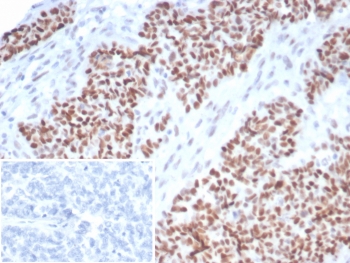 IHC staining of FFPE human ovarian carcinoma tissue with recombinant p53 antibody (clone TP53/7082R). Inset: PBS used in place of primary Ab (secondary Ab negative control). HIER: boil tissue sections in pH 9 10mM Tris with 1mM EDTA for 20 min and allow to cool before testing.~